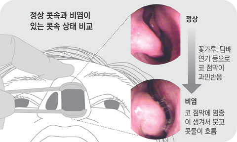 비염의 증상과 원인은 무엇이며 치료하는 방법은 어떤 것이 있나