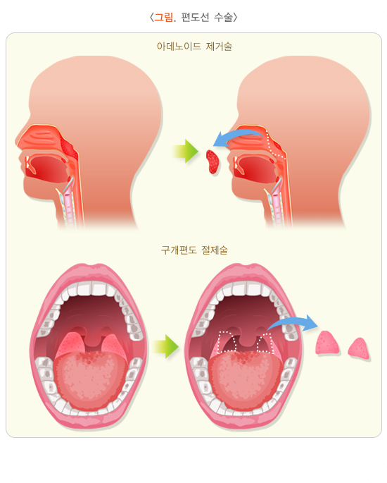 편도선염의 원인과 증상, 치료는 어떻게 할까