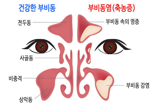 부비동염(축농증)의 원인과 증상 및 치료법
