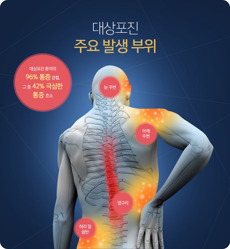 대상포진의 원인과 증상, 그리고 치료법