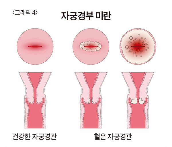 자궁 경부 미란(헐음)의 증상과 원인, 치료법 알아보기