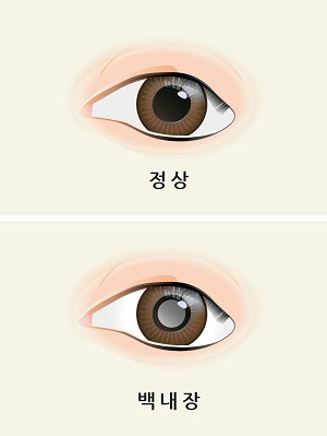 백내장의 원인과 증상 그리고 치료법