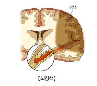 뇌경색의 원인과 증상 치료와 관리법