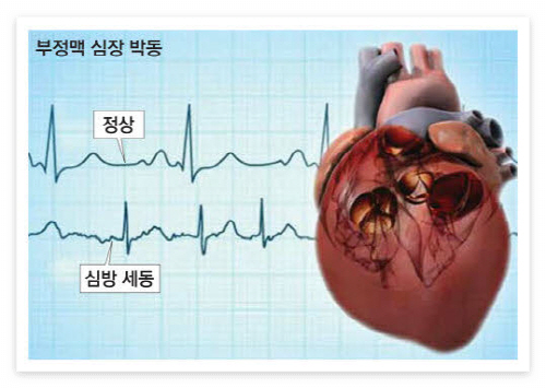 부정맥의 원인과 증상 및 치료법(예방법)