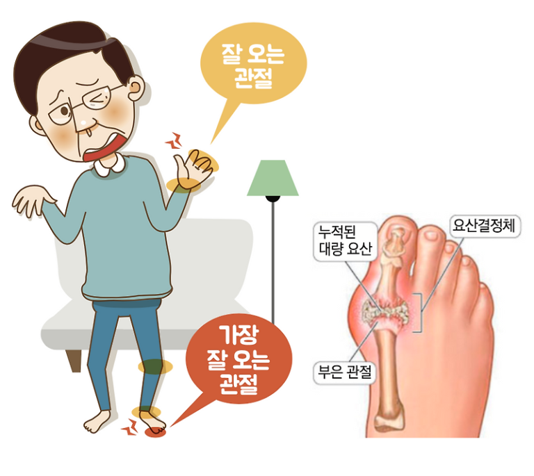 통풍의 원인과 증상을 이해하고 관리하는 방법