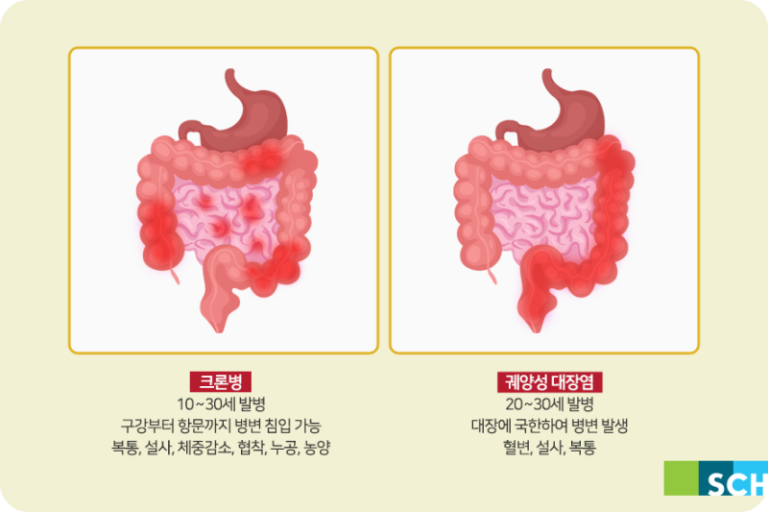 크론병과 궤양성 대장염의 차이점은 무엇인가요?