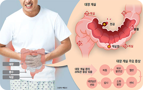 대장 게실염의 원인과 증상 및 치료와 예방, 재발의 위험을 피하려면?