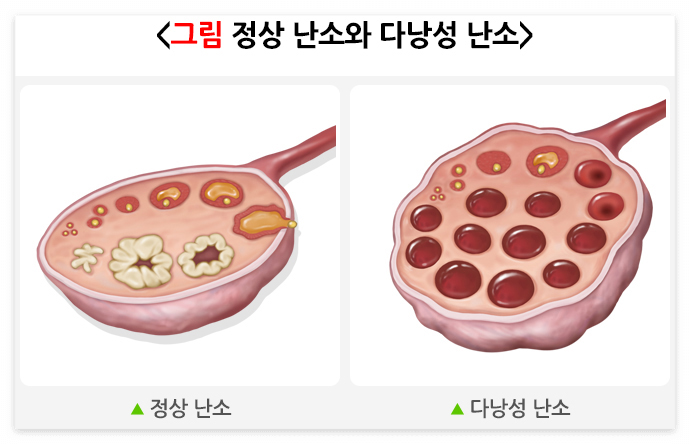 다낭성 난소 증후군(PCOS)의 증상 및 치료법
