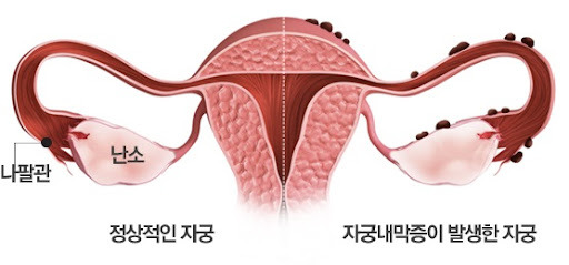 자궁내막증의 증상과 진단 및 치료