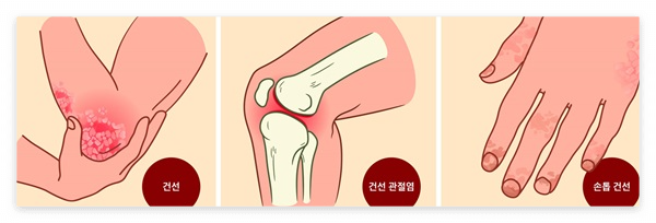 만성 피부 질환인 건선의 원인과 증상, 치료하는 방법