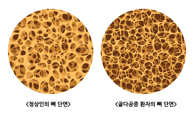 골다공증의 원인과 증상 및 예방하는 방법은 무엇일까